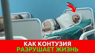 Что такое КОНТУЗИЯ и ее Последствия | Что чувствует Человек при КОНТУЗИИ | Лечится ли КОНТУЗИЯ