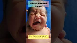 congenital absence of depressor angularis oris muscle |  #crying-baby #nicu  #shorts