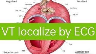 #VentricularTachycardia localization Using 12 lead #ECG  #VT #VTlocalisation  #epstudy