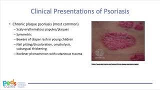 Approach to Pediatric Psoriasis