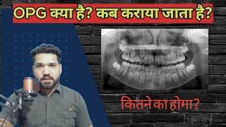 OPG / मुँह का बड़ा x-ray क्या होता है? कब कराया जाता है? कितने रूपए लगेंगे??