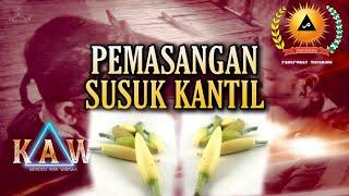 Pemasangan Susuk Kantil