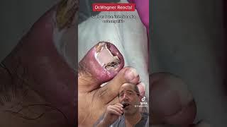 SUPER INFECTED INGROWN TOENAIL#shorts #ingrown_toenail