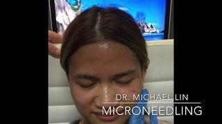 Microneedling with Dr. Michael Lin!