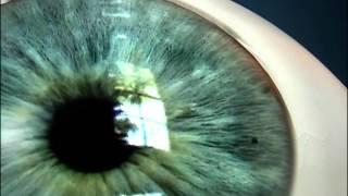 Laser Iridotomy for Angle Closure Glaucoma