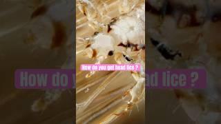 How do you get head lice? l lice removal l head lice Treatment