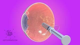 eye medical animation treatment