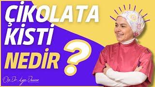 Çikolata Kisti Nedir? Neden Olur? Tedavi Edilebilir mi?