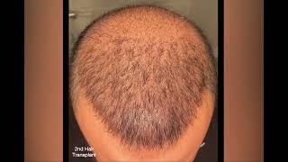 DHI Hair Transplant-  [ 14 weeks result ] 4300 graft