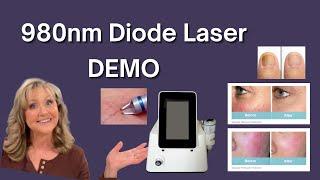 980nm Diode Laser DEMO | ZAP SPIDER VEINS!!! |TOE NAIL FUNGUS GONE!!!