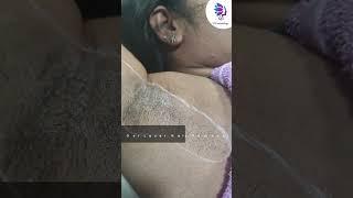 Get Rid of under-arm hair by Laser Hair Removal Treatment | VJ’s Cosmetology Clinic