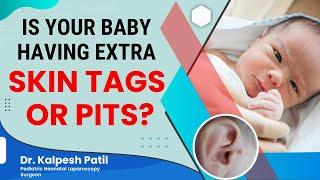 Is Your Baby Having Extra Skin Tags Or Pits In Front Of The External Ear | Dr. Kalpesh Patil