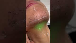 Laser hair removal on the chin