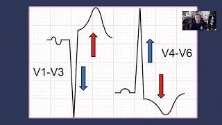 Left Ventricular Hypertrophy