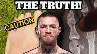 Conor McGregor Broke his Pinky Toe and Couldn’t Fight - Doctor Explains