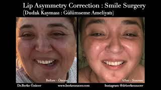 Lip Asymmetry Treatment: Smile Surgery  - Gülerken Dudak Kayması, Gülerken Ağız Kayması