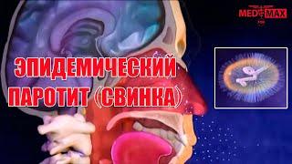 Эпидемический паротит (свинка) #свинка #инфекции #паротит #детскоездоровье #дети #ребенок #вирус