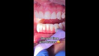 What happens if you get braces a second time? Tooth Time Family Dentistry New Braunfels Texas