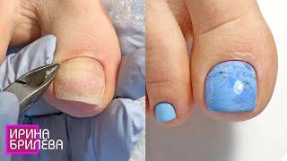 PEDICURE  Hyperhidrosis  Treatment of feet and toes  Irina Brilyova (English SUBTITLES)