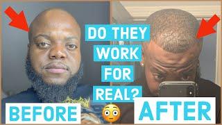 MIRACLE DROPS+ WILD GROWTH OIL GREW MY HAIR LINE BACK! | BEFORE AND AFTER PICTURES