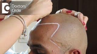 What is processing time of Hair Transplantation? - Dr. Niranjana Raj