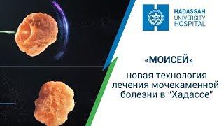 “Моисей” - новая технология лечения мочекаменной болезни в “Хадассе”