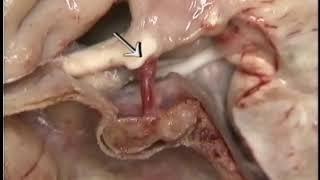 ANATOMIE FMPM  GLANDE HYPOPHYSAIRE DISSECTION