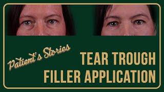 Tear Trough Filler Application - Dr. Baris Yigit