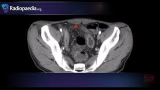 Comb sign of Crohn's disease - radiology video tutorial (CT)