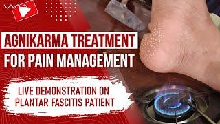 Agnikarma treatment for Pain Management | Live demonstration on Plantar Fascitis patient