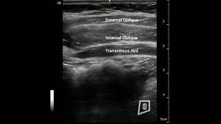 Rehabilitative Ultrasound Imaging of the Transversus Abdominis