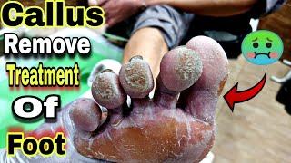 Pedicure,Callus,Remove tutorial  |Footcare33