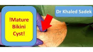 Bikini Line Cyst. LipomaCyst.com Dr Khaled Sadek