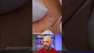 Please don't play with your cysts #dermreacts #doctorreacts #pimplepopper #cystpop