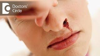 What are the causes of sudden nose bleed? - Dr. Lakshmi Ponnathpur