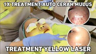 Treatment Yellow Laser di ZAP Surabaya‼️Laser Untuk Mencerahkan Kulit