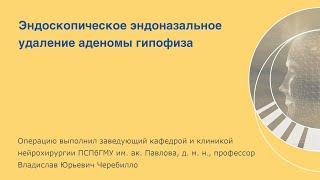 Эндоскопическое эндоназальное удаление аденомы гипофиза