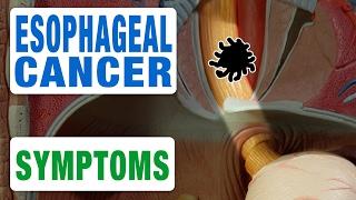 Esophageal Cancer - All Symptoms