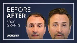 COSMEDICA DR.ACAR ,3000 Grafts  FUE Hair Transplant,Turkey-Istanbul