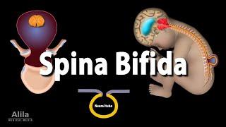 Spina Bifida, Animation