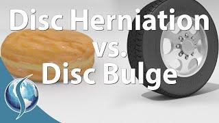 Herniation vs Bulge