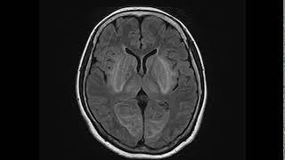 STEC-hemolytic uremic syndrome (HUS) and encephalopathy