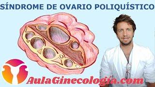 SÍNDROME de OVARIO POLIQUÍSTICO: causas, síntomas y diagnóstico.   - Ginecología y Obstetricia -