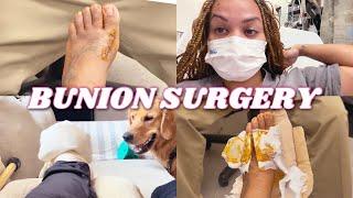 BUNION SURGERY  | Healing process, Pain, Sutures Removal, Recovery 