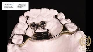 TAD anchored palatal expansion appliance by Dr.Svitlana Koval, MSc