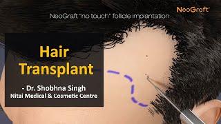 Hair Transplant | Neograft's New Hair transplantation Solution | Nitai Medical and Cosmetic Centre