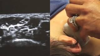 Ultrasound Guided Interscalene Nerve Block - SSRAUSA.com