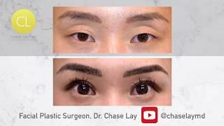 #ChaseLayMD Asian Eyelid Surgery Before and Afters