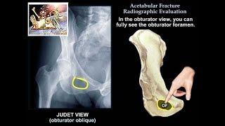 Acetabular Fracture Radiographic Evaluation - Everything You Need To Know - Dr. Nabil Ebraheim