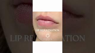 LIP REJUVENATION | SKIN CLINIC IN DUBAI #Dubai #dubaibeauty #dubaiclinic #lipcare #liprejuvenation